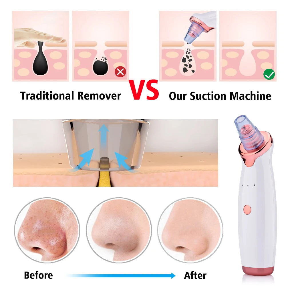 Élimination électrique des points noirs sous vide, nettoyage du visage des taches noires, aspiration des boutons d'acné, Instrument de beauté, outils de soins de la peau